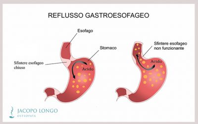 Osteopatia e reflusso gastroesofageo