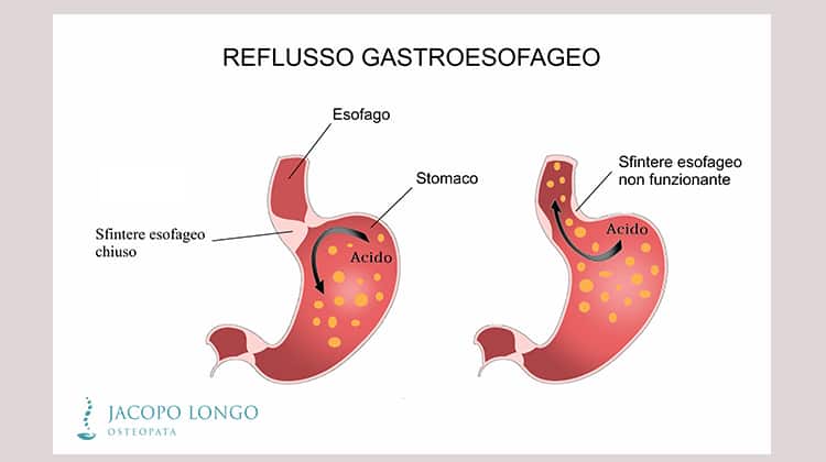 Osteopatia e reflusso gastroesofageo - Jacopo Longo